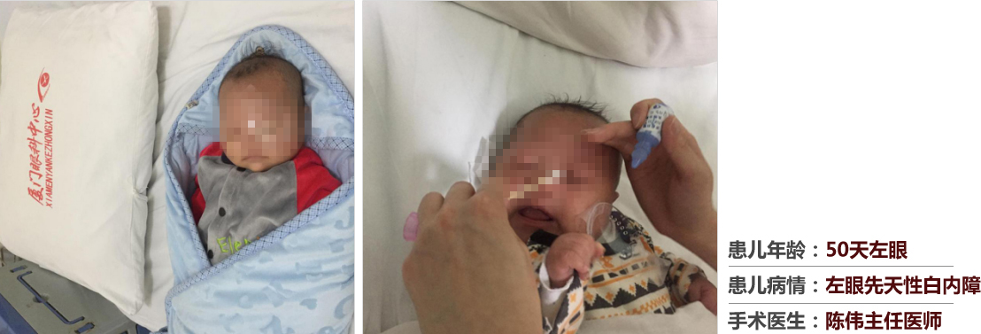 患兒年齡：50天左眼，患兒病情：左眼先天性白內障，手術醫(yī)生：白內障科陳偉主任醫(yī)師