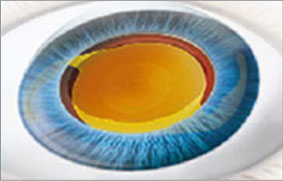 第4步:晶體展開(kāi)手術(shù)完成