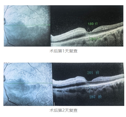 視網膜中央動脈阻塞